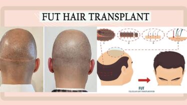 FUT Hair Transplant: Is It the Permanent Hair Treatment for Hair Loss?