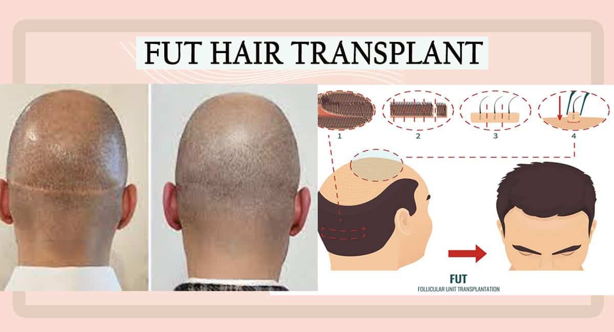 FUT Hair Transplant: Is It the Permanent Hair Treatment for Hair Loss?