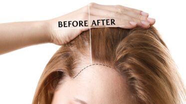 alopecia areata- What is Alopecia areata? Causes and Hair Treatments