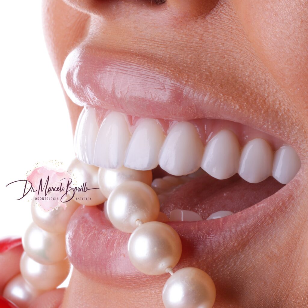 Dental Contact Lens in Porto Alegre Dreams wire