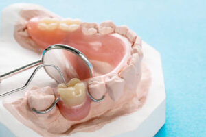 removable partial denture