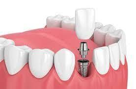 3 Reasons Why Dental Implants Are Necessary