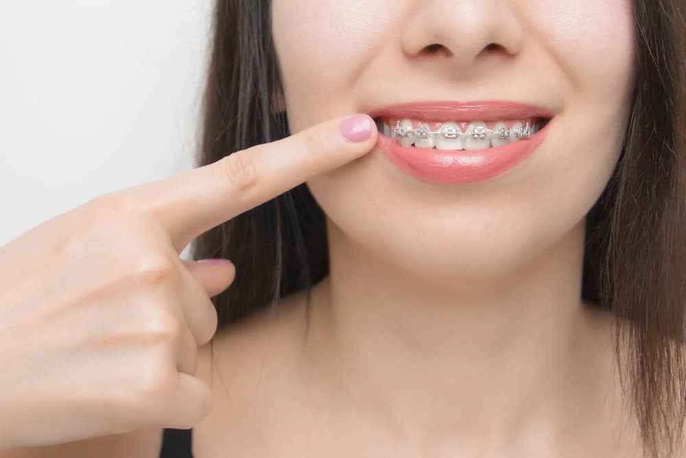 Is Orthodontic Wax Edible? Amazing Facts You Need to Know to Eat