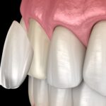 Exploring Veneer Options for the Ultimate Sydney Smile Makeover