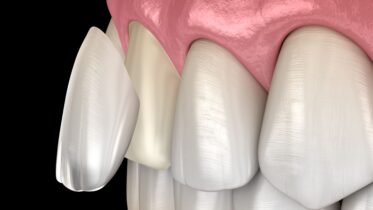Exploring Veneer Options for the Ultimate Sydney Smile Makeover