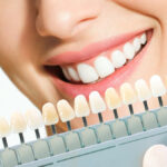 A Guide to Veneers and Cosmetic Dentistry in Sydney