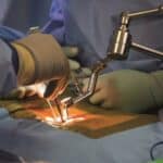 AI and the Future of Spinal Surgery